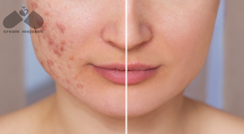 انتخاب کرم مناسب بر اساس نوع پوست و شدت لک‌ها