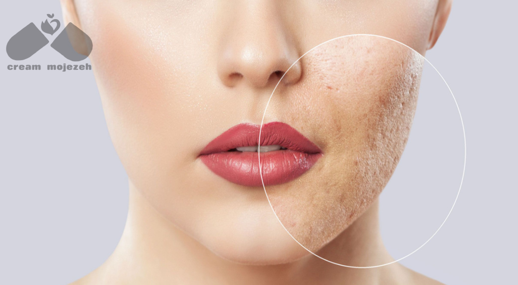 انواع جای جوش و تأثیر آن‌ها بر انتخاب روش درمان