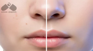 تأثیر کرم ضد لک در شفافیت پوست